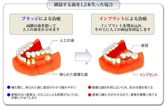隣接する歯を1,2本失った場合