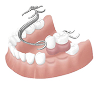 ◯部分入れ歯による治療