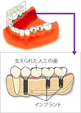 ◯インプラントによる治療