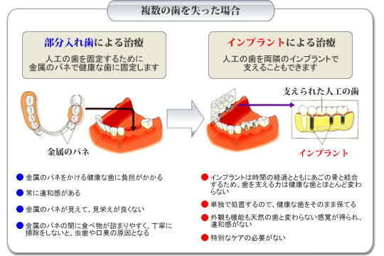 複数の歯を失った場合