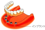 ◯インプラントによる治療