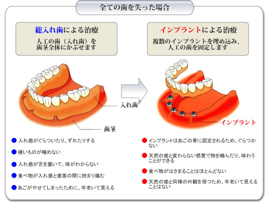 全ての歯を失った場合