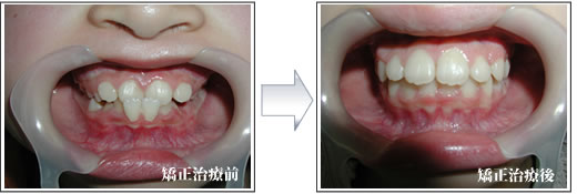 矯正治療症例